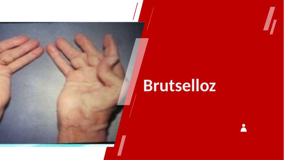 Brusellyoz