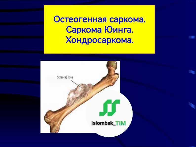 Остеогенная саркома. Саркома Юинга. Хондросаркома