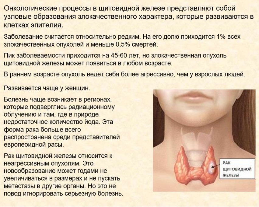 Рак щитовидной железы