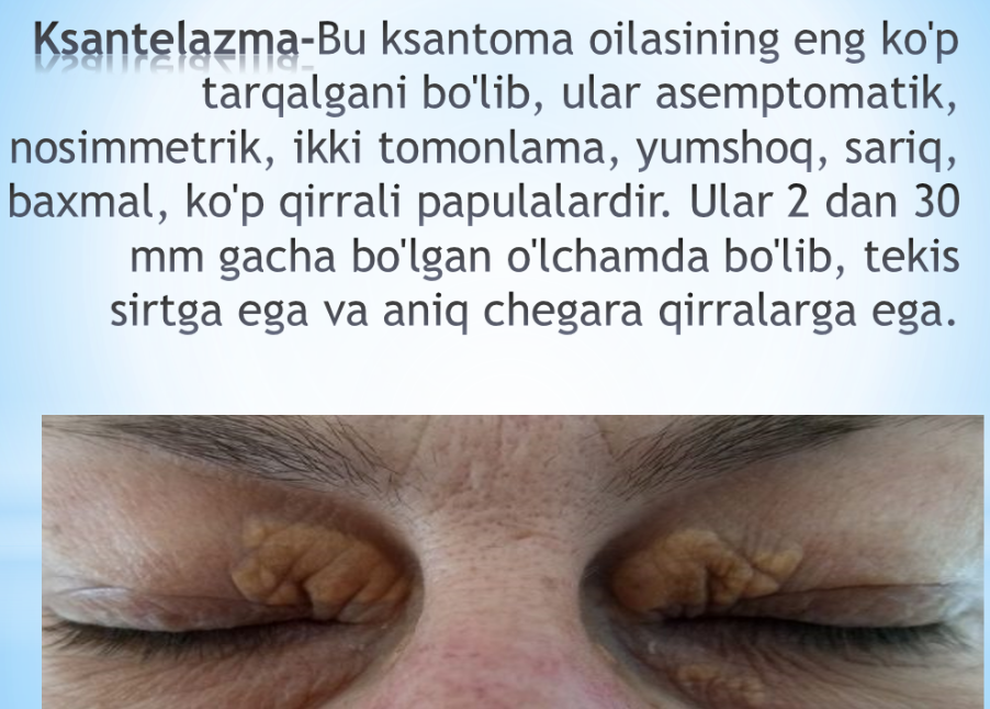 Ksantelazma.Lipoma.Gigroma