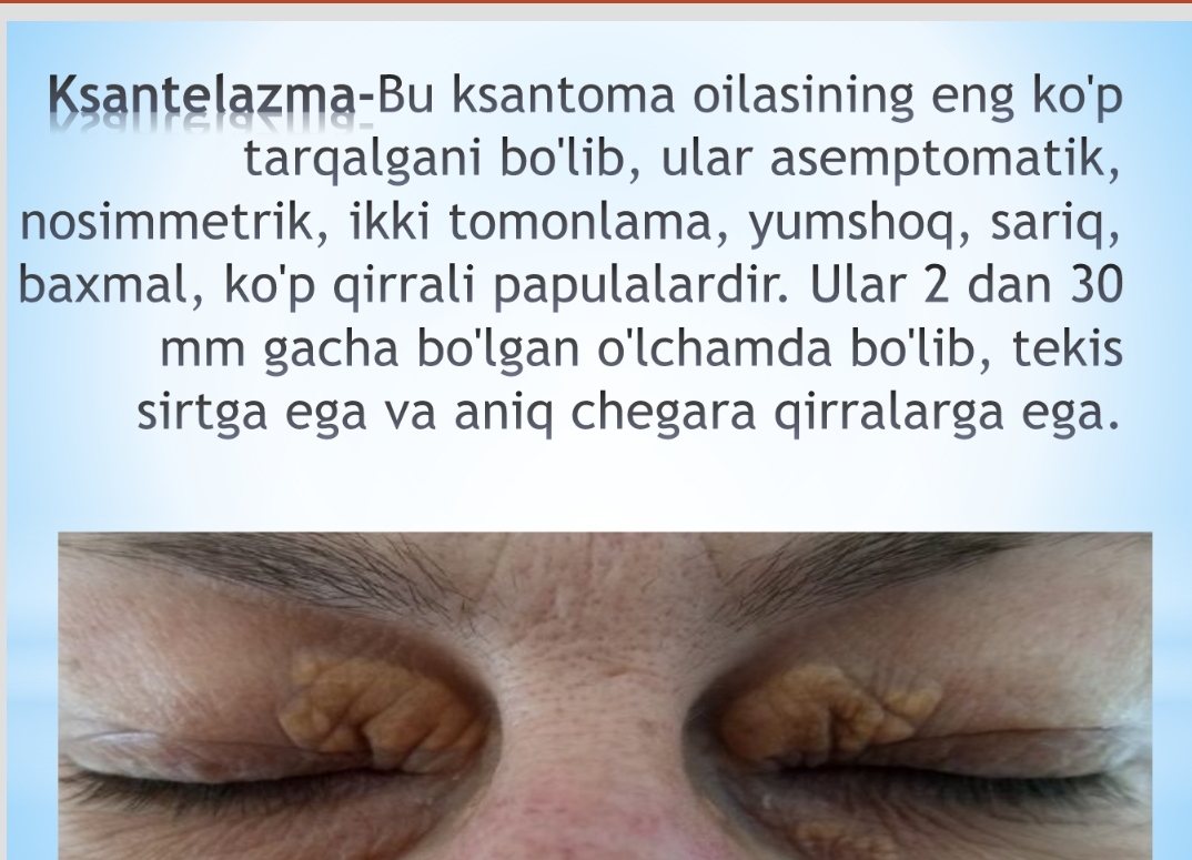 Ksantelazma , lipoma , gigroma