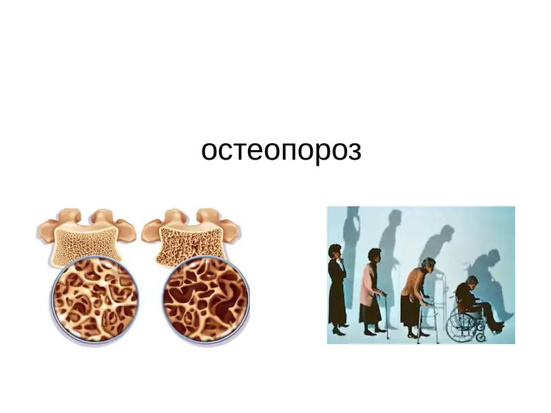 Остеопороз