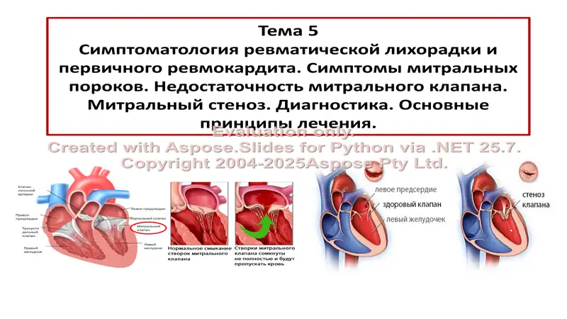 Симптоматология ревматической лихорадки и первичного ревмокардита