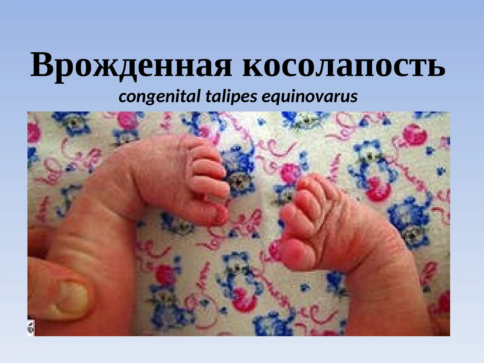 Врожденная косолапость (Congenital talipes equinovarus)