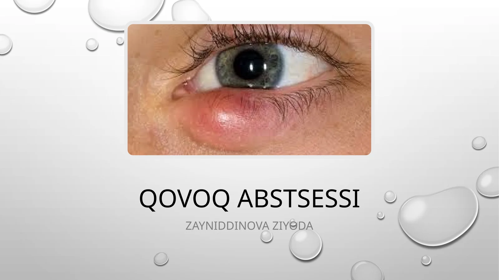 Qovoq abstsessi