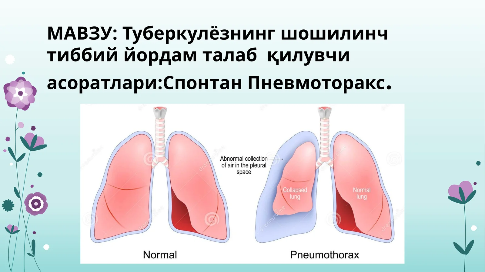 Tuberkulyozning shoshilinch tibbiy yordam talabqiluvchi asoratlari:Spontan Pnevmotoraks