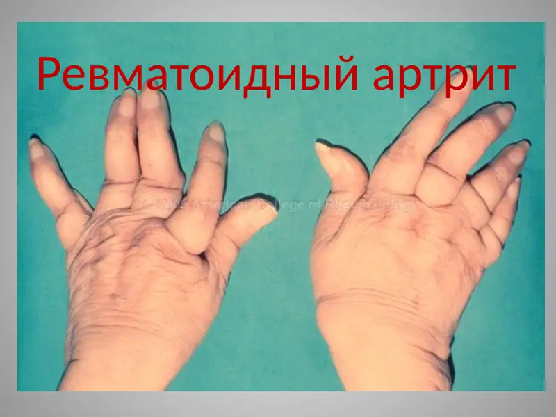 Ревматоидный артрит
