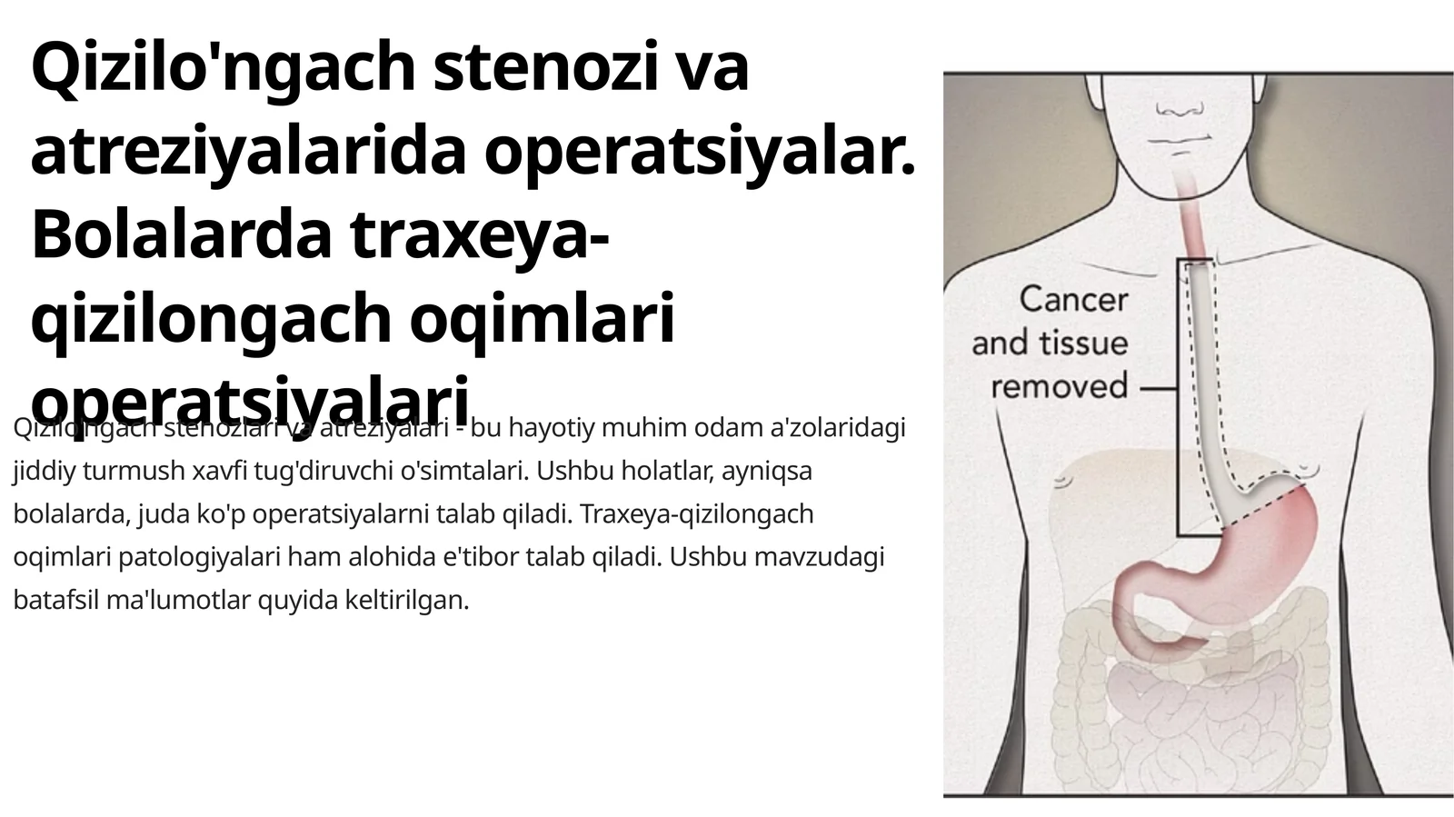 Qizilo'ngach stenozi va atreziyalarida operatsiyalar. Bolalarda traxeya-qizilongach oqimlari operatsiyalari