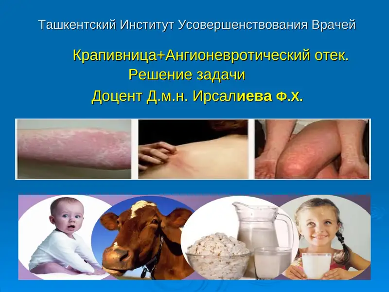 Крапивница